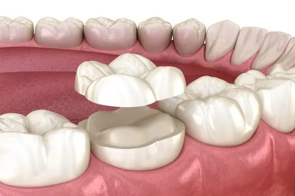 Step 7: Final Restoration Placement