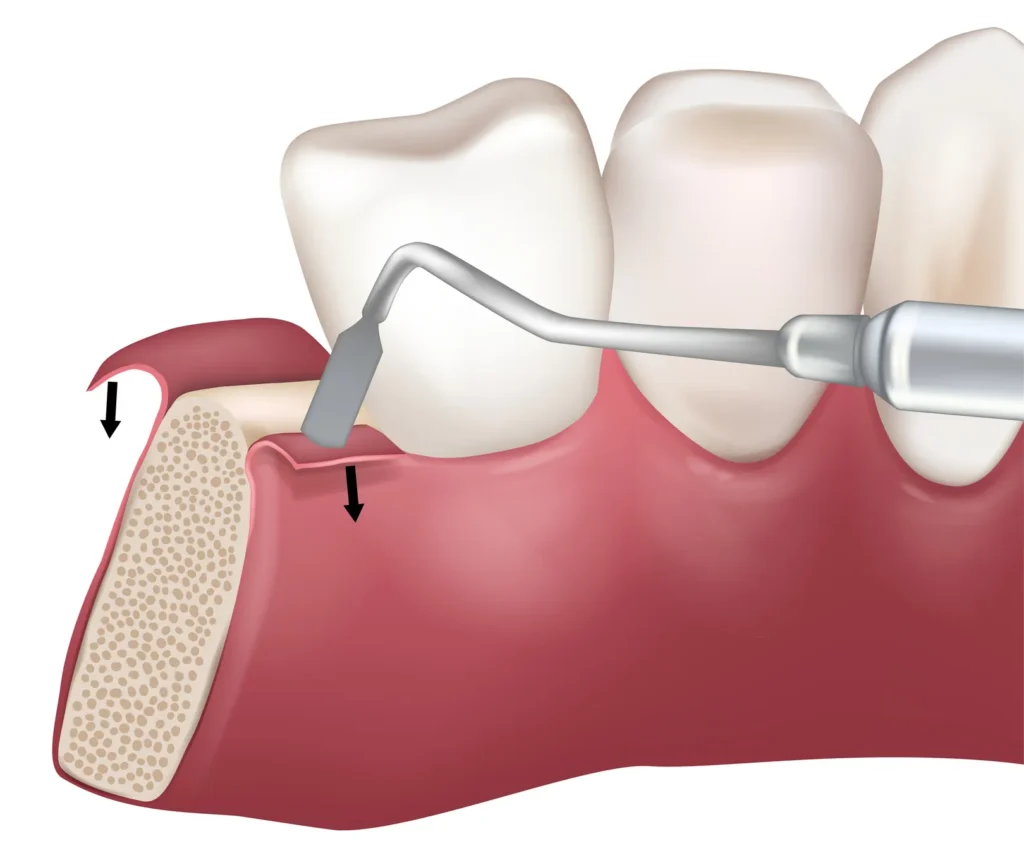 Guided Tissue Regeneration