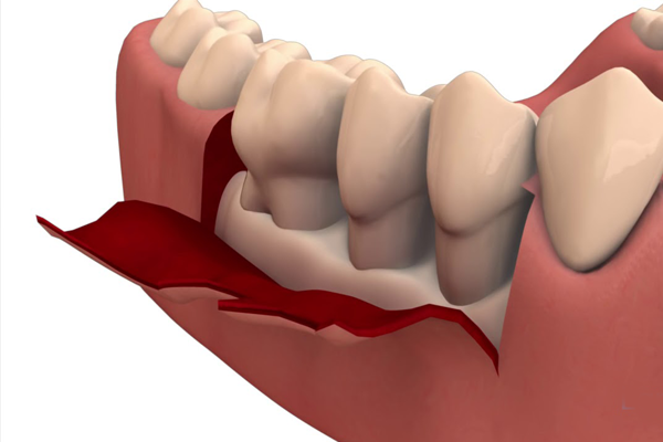 Flap Surgery (Gum Surgery)