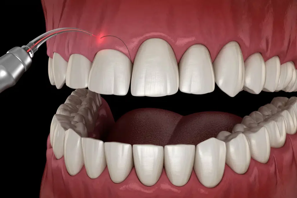Laser Frenectomy