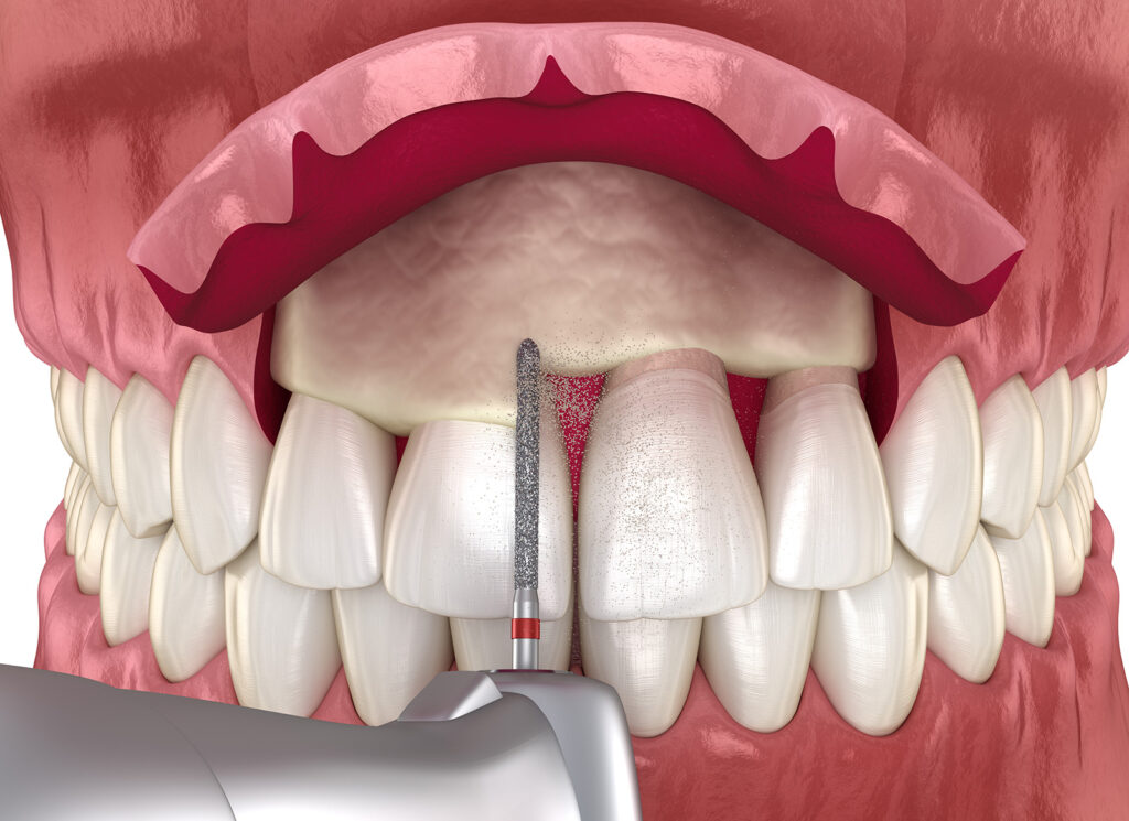 Crown Lengthening