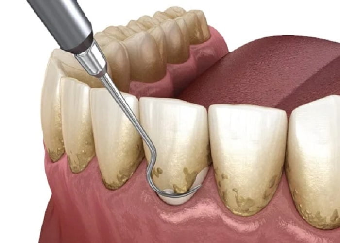 Scaling & Root Planing (Deep Cleaning)