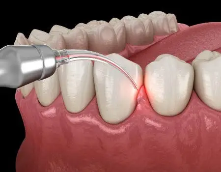 Laser Gum Treatment (for Bleeding Gums & Periodontitis)