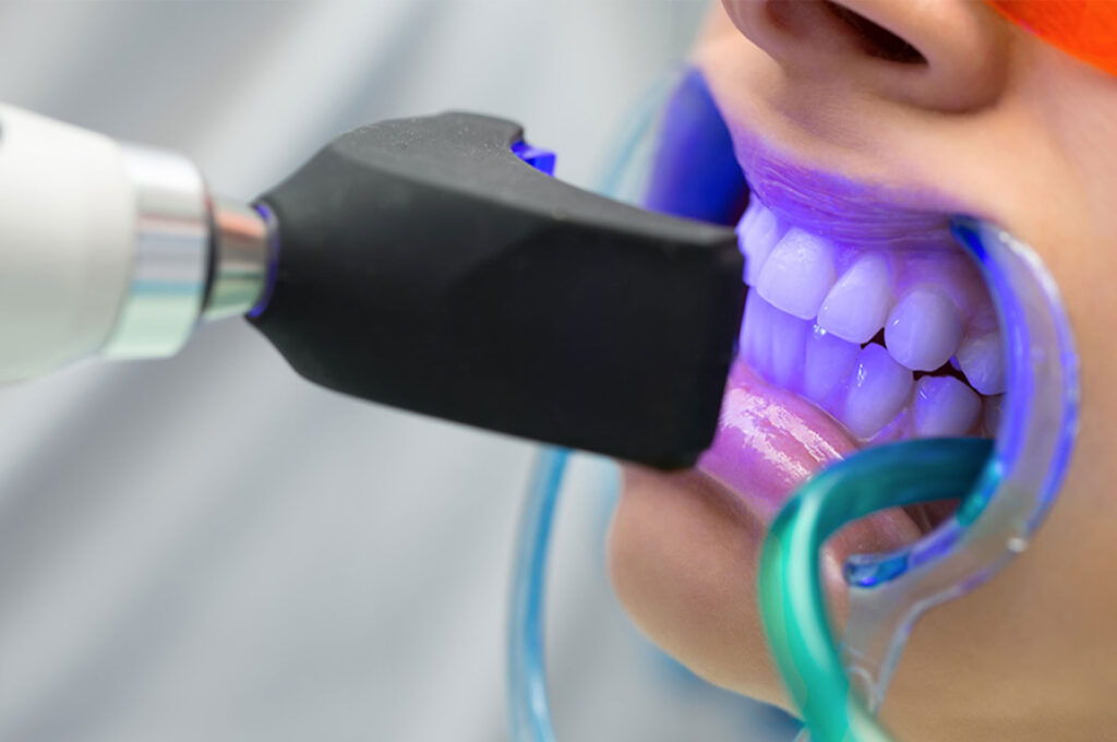 Laser Teeth Whitening