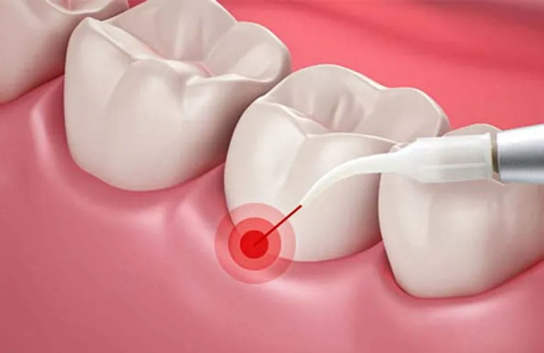 Laser Gum Treatment