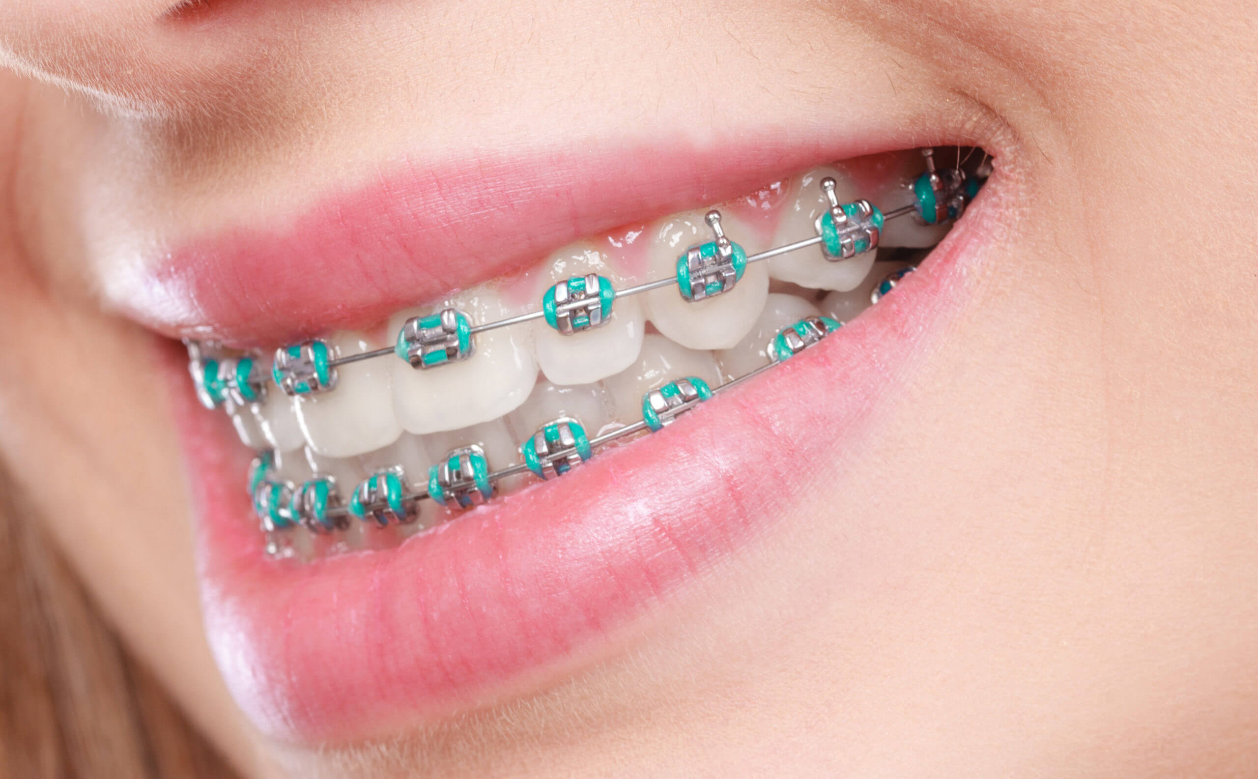 Braces,Aligners, Airway and Growth