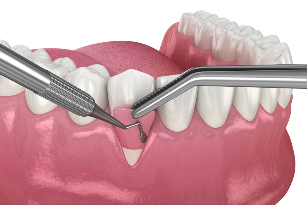 Soft Tissue Grafting (Gum Graft)