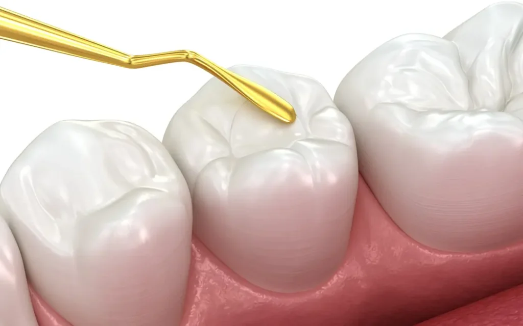 Dental Sealants
