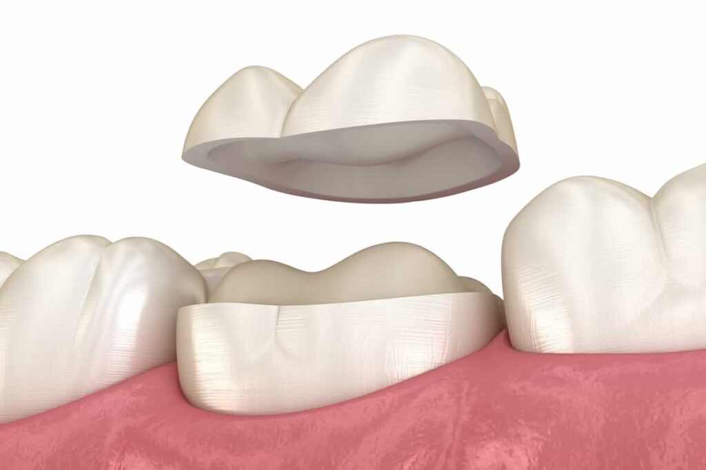 Inlays, Onlays, Endocrowns & Other Restorations