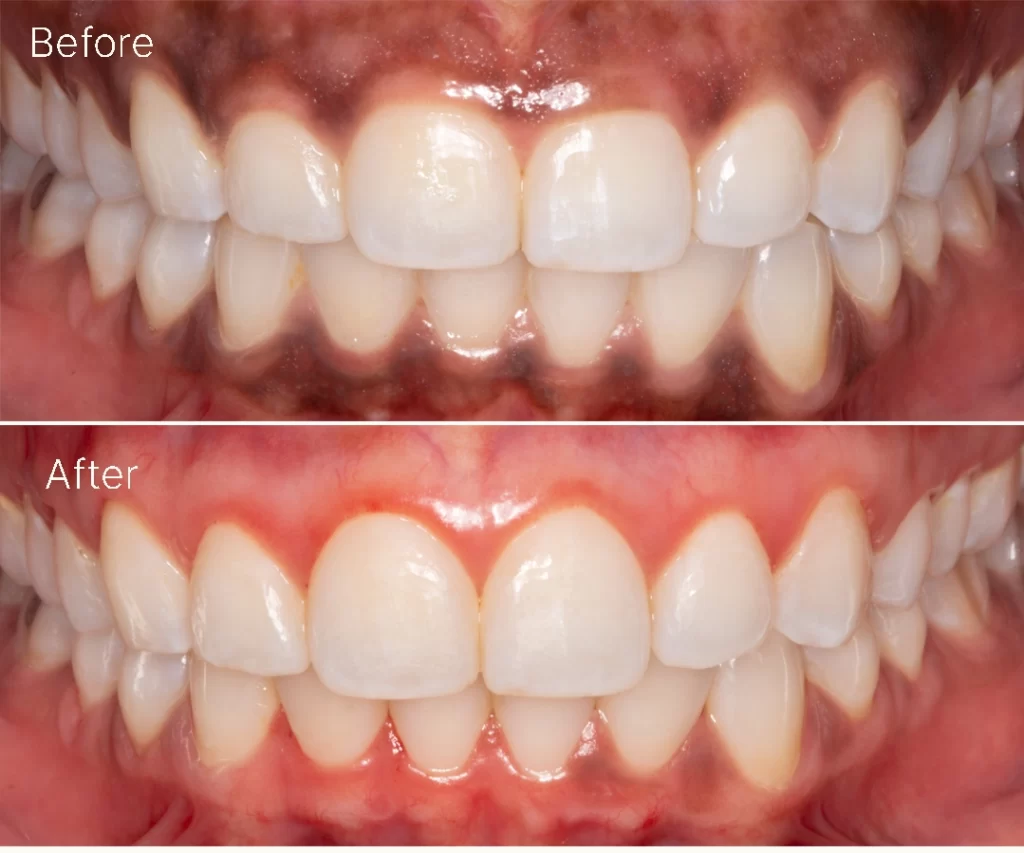 Gum Depigmentation (Gum Lightening)