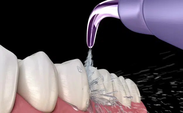 Step3: Surface Conditioning for Enhanced Bonding