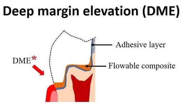 Step 5: Deep Margin Elevation.