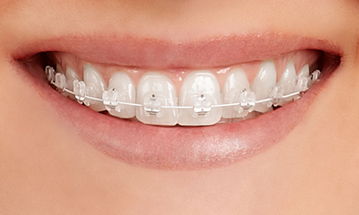 Self-Ligating cermic Braces