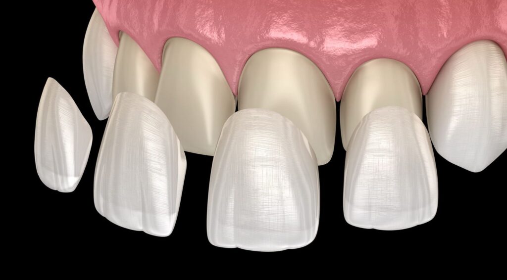Smile Makeover ( Veneers/ Crowns)