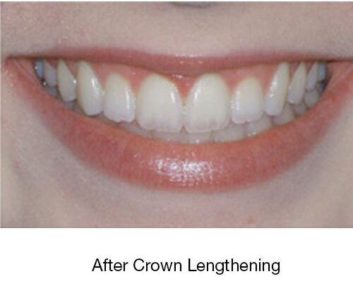 After Crown Lenghthering