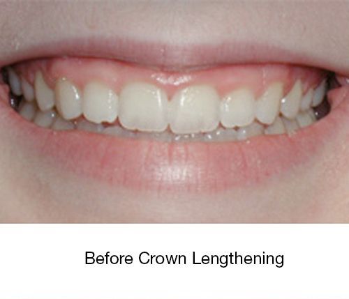 Before Crown Lenghthering