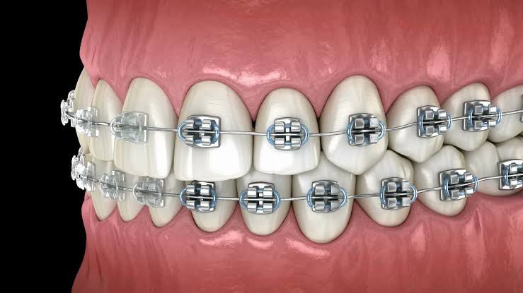 Crown Lengthening