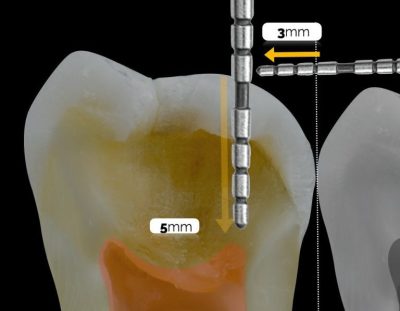 Step 2: Selective Caries Removal .